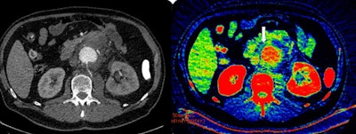On the left is contrast-enhanced axial CT scan of the abdomen in a patient with suspected rupture of abdominal aortic aneurysm. Leakage of blood from the aorta (center) is not obvious. On the right is the corresponding dual-energy CT scan (iodine map). Concentration of iodine corresponds to gradations of the recolor scale. White arrow indicates high concentration of iodine (yellow-green areas inside the blue nonenhancing tissues) in the blood leaking into the para-aortic tissues from the small contained aortic wall rupture (later confirmed in surgery). Images courtesy of Dr. Valentin Sinitsyn.