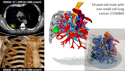 Hybrid 3D printing fuses CT scans and MR images to create 3D models of lungs. Image courtesy of Dr. Jordi Broncano.