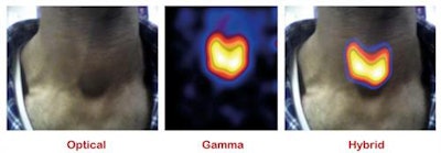 A clinical study of thyroid gland imaging, showing optical, gamma, and hybrid images of the neck at 100 mm (300 seconds acquisition time) 1 hour 50 minutes after injection of I-123 NaI. Image courtesy of John Lees.