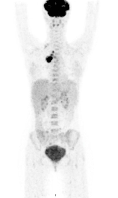 Maximum intensity projection image of F-18 FDG PET/CT scan of a patient with Hodgkin lymphoma demonstrating hypermetabolic disease limited to the mediastinum. All images courtesy of Dr. Mykola Novikov.