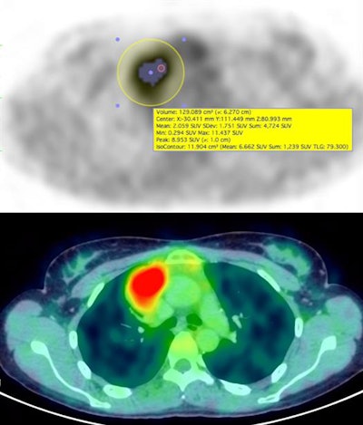Axial PET and fused PET/CT image of the same patient with Volume of Interest marking for quantitative assessment of F-18 FDG uptake in mediastinal adenopathy, providing values of different quantitative metrics.