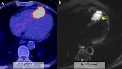 A 60-year-old man with head and neck squamous cell carcinoma, syncope, and negative T waves in the anterior wall. During the initial examination a hypermetabolic lesion in the apical septum and apex of the right ventricle was seen (A). It shows severe restriction to DWI (apparent diffusion coefficient: 0.73 x 10-3 mm2/s; B, C, and D; yellow arrows). Mild hyperintensity in T2 short tau inversion recovery (F; blue arrow) and heterogeneous enhancement (E; red arrow). All images courtesy of Dr. Jordi Broncano Cabrero.