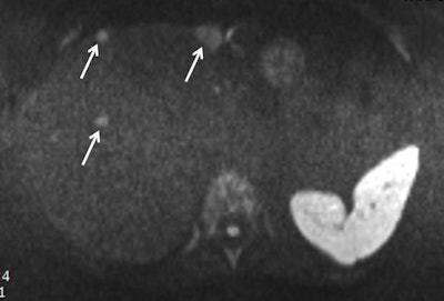 Prise lors d'un bref protocole, cette image pondérée en diffusion montre des métastases hépatiques évidentes chez un patient. Les lésions sont indiquées par des flèches. Image Dr. Thomas Lauenstein. Image publiée initialement dans ECR Today le 1er mars 2018.