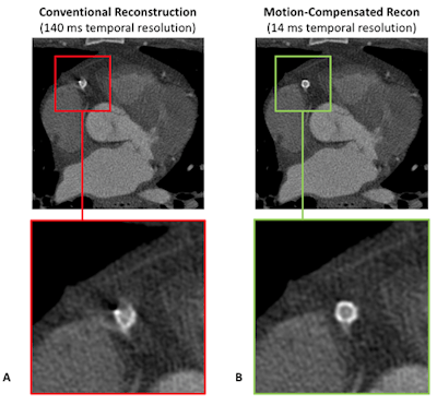 Figure 1: Although the temporal resolution is quite high, the coronary stent is not well visualized in the conventional reconstruction (A). The motion-compensated reconstruction, which mathematically models the motion of each voxel and accounts for that motion during image reconstruction, achieves a 10-times higher temporal resolution, and, thus, correctly depicts the implant (B).