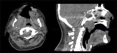Figure 2: Motion artifact in head scan with head frame immobilization originating from residual motion of the spine.