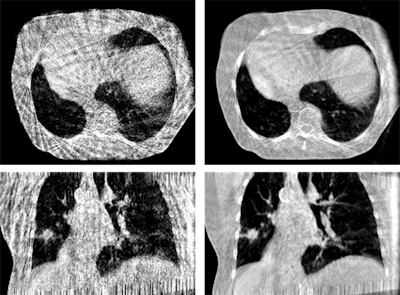 Figure 3: Phase-correlated (left) and motion-compensated (right) reconstruction of a thorax scan. The MoCo reconstruction is constrained by cyclic motion and uses an artifact model and phase to amplitude resampling to improve image quality.