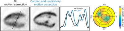 Figure 4: Long-axis slices showing F-18 FDG PET uptake in the myocardium and papillary muscles without motion correction and with cardiac and respiratory motion correction. Improved depiction of the uptake structures is also visible in the line plot. Motion correction improved the measured uptake by more than 25% on average.