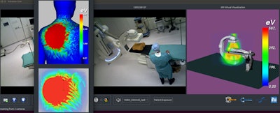 Visualization of the simulated dose to the skin and the organs of a patient model, updated according to the current C-arm angulation and imaging parameters, as shown by the system's GUI.