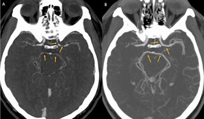 A: CT angiography showing unexpected luminal narrowing in the left supraclinoid internal carotid artery, M1 segment of bilateral middle cerebral arteries, and P1 segments of bilateral posterior cerebral arteries consistent with vasospasm. B: CT angiography showing resolution of luminal narrowing after five weeks of supportive care. Images courtesy of BMJ Case Reports 2018.