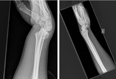Lateral radiographs demonstrate a fracture (left) and no fracture (right). Notice how much of the image is surplus to the diagnosis. All images courtesy of Dr. Dan Kim, Royal Devon & Exeter Hospital, U.K.