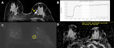 Invasive ductal carcinoma in the left breast of a 71-year-old woman. (A) On DCE-MRI, there is a 10-mm irregular-shaped, marginated lesion (arrow) with (B) initial fast/plateau enhancement. DCE-MRI findings were classified as suspicious for malignancy (BI-RADS 4). DWI was false-negative, as none of the readers called the lesion on DWI alone. However, when mpMRI combined DCE-MRI and DWI, readers identified a (C) hyperintense correlate (circle) with an (D) apparent diffusion coefficient (ADC) of 1.111 x 10-3 mm2/sec, which further confirmed malignancy. Images courtesy of Dr. Katja Pinker, PhD.