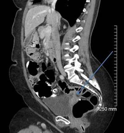 2018 04 20 16 18 5606 2018 04 19 Ct Fistula 4a 20180420164935