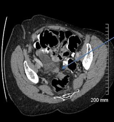 2018 04 20 16 18 5762 2018 04 19 Ct Fistula 6a 20180420165014