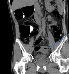 2018 04 20 16 18 6075 2018 04 19 Ct Fistula 26a 20180420165051
