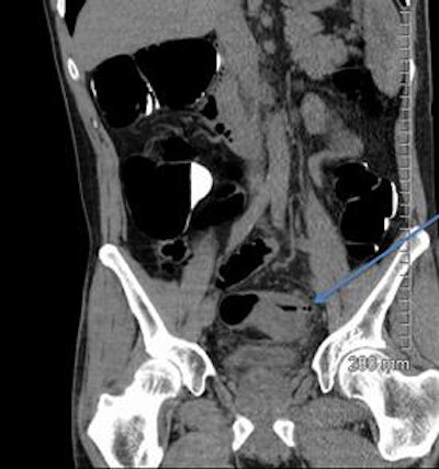 2018 04 20 16 18 6075 2018 04 19 Ct Fistula 26a 20180420165051