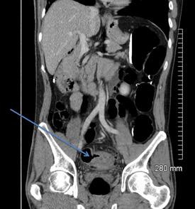 2018 04 20 16 18 6075 2018 04 19 Ct Fistula 28a 20180420165126