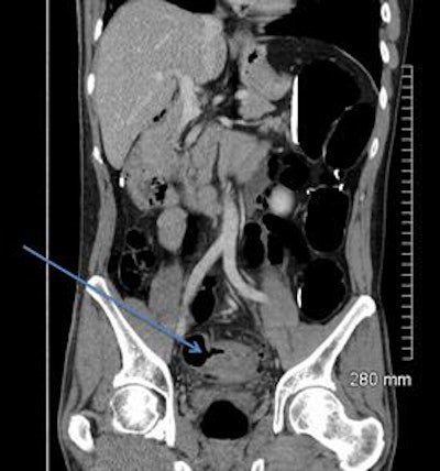 2018 04 20 16 18 6075 2018 04 19 Ct Fistula 28a 20180420165126