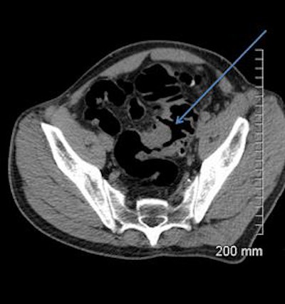 2018 04 20 16 18 6231 2018 04 19 Ct Fistula 30a 20180420165157