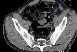 2018 04 20 16 18 6231 2018 04 19 Ct Fistula 30a 20180423150809