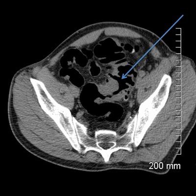 2018 04 20 16 18 6231 2018 04 19 Ct Fistula 30a 20180423150809