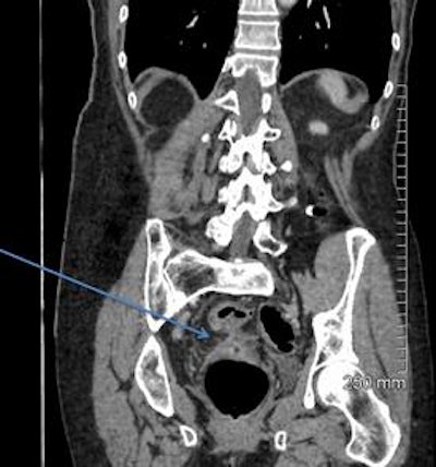 2018 04 20 16 18 6544 2018 04 19 Ct Fistula A 20180420165233