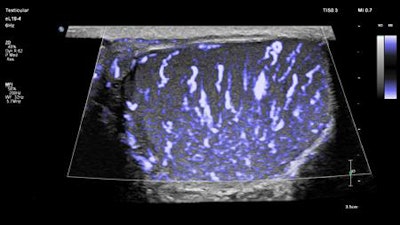 High-resolution image of the testicle using ultrabroadband PureWave eL18-4 transducer from Philips demonstrates subtle vascular flow with MicroFlow Imaging.