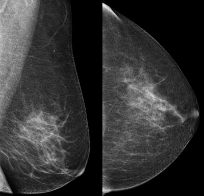 Top: Oblique and craniocaudal screening mammograms of a 51-year-old woman show no abnormality. Below: Ultrasound shows a 7-mm ductal invasive carcinoma (calipers). Bottom: Oblique and craniocaudal mammograms after ultrasound-guided core needle biopsy show clipmarker at biopsy site (arrow). All images courtesy of Dr. Wolfgang Buchberger.