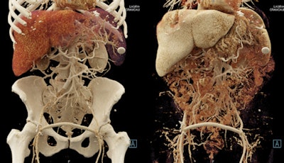 Cinematic rendering creates lifelike photorealistic images. Image courtesy of Dr. Elliot Fishman.