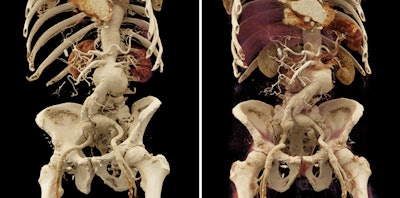Cinematic-rendered images of a large abdominal aortic aneurysm. Courtesy of Dr. Steven Rowe, PhD.