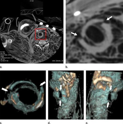 Cricoid cartilage of a 27-year-old woman who died of strangulation, visualized in an axial cervical postmortem CT scan (a, b) and volume-rendered 3D reconstructions (c-e). CT angiography revealed a bilateral fracture that proved difficult to demonstrate clearly with autopsy.