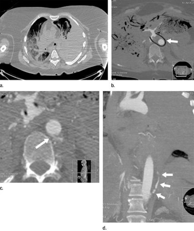 Postmortem CT (a) and postmortem CT angiography (b-d) scans of a 59-year-old woman who died of internal exsanguination soon after Whipple surgery. All images courtesy of RSNA.