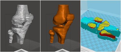 From left to right: Rough and smooth stereolithography models. Preview of temporary printing supports and printing parameters (layer height 0.2 mm, shell thickness 1.2 mm, bottom/top thickness 1.2 mm, fill density 5%). All images courtesy of Dr. Luca Jacopo Pavan.
