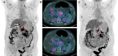 Images show FDG-PET and CT scans of a patient before and after treatment. A: FDG-PET before Lu-177 3BP-227 treatment (red oval: primary tumor; arrows: liver metastases). Upper panel of B: Axial CT section showing primary tumor (blue oval) before therapy. Lower panel of B: Axial CT section after three cycles of Lu-177 3BP-227. C: FDG-PET after three cycles of therapy. Images courtesy of Baum et al and JNM.