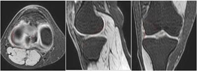 Measurements of graft length on multiplanar reconstruction images (from left to right: axial, sagittal, and coronal planes).