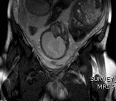 MRI (coronal survey image) of the placenta in a 31-week gestational age twin pregnancy shows kissing placentae. All images courtesy of Dr. Papaioannou Georgia, Panagiotis Tagalakis, and Dr. Christina Malamateniou.