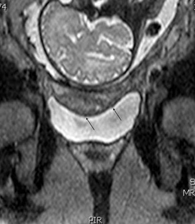 Better bladder filling after maternal hydration allows for further identification of areas of focal invasion of the uterine wall and possibly the bladder wall (arrows) from the anterior placenta, which was characterized increta and possibly percreta. On surgery, invasion of the bladder wall was not confirmed.