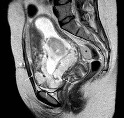 Sagittal single-shot T2-weighted image through the pelvis in a 16-week gestational age pregnant woman with acute onset of hypotension and vaginal bleeding. A placenta previa was identified with an abnormal contour of the inferior part of the uterus and loss of visualization of the normal uterine wall (arrows). Additionally, a bloody collection was identified in the rectouterine recess (*). Uterine rupture was confirmed intraoperatively.