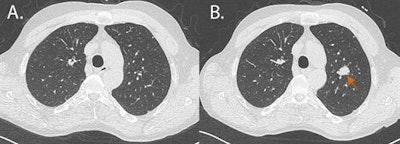 A 59-year-old heavy smoker participated in the German lung tumor screening and intervention (LUSI) study. A: Baseline examination without round lesion. B: One-year follow-up: new 15-mm round lesion (arrow). The histology showed a poorly differentiated pT1b adenocarcinoma. Five years later, the patient was still tumor-free. All images courtesy of Dr. Hans-Ulrich Kauczor.