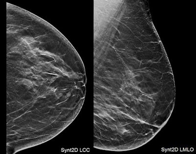 Top: Small, ill-defined mass identified scrolling through DBT slices. Bottom: DBT spot-compression views emphasized the tiny spiculations, increasing the level of suspicion (the lesion was classified BI-RADS 5 category). All images courtesy of Dr. Daniela Bernardi.
