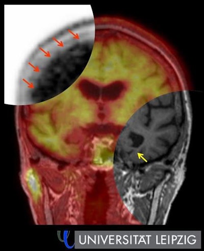 Hybrid amyloid PET/MRI in Alzheimer's disease. Top left: Evidence of amyloid plaques in the cerebral cortex (red arrow) using PET. Bottom right: Signs of hippocampus shrinkage (yellow arrow) with simultaneous MRI. Image courtesy of Leipzig University.