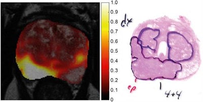 Images show a central slice (left) through tumor probability map of a 64-year-old patient, fused with T2-weighted MR image for anatomic reference. Region with highest tumor probability values (right) correspond to peripheral-zone tumor with Gleason score of 4 + 4, as verified by histopathology. Images courtesy of Journal of Nuclear Medicine.
