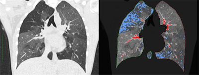 Left: Regular CT for suspected COPD. Right: Overlaid qCT. The blue areas represent the typical 'air trapping' seen in COPD. The red sections only show vessels and have no pathological value. All images courtesy of Dr. Joshua Gawlitza.