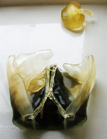 The father's 3D-printed kidney (top). The son's 3D-printed abdomen (bottom). Image courtesy of Stratasys.