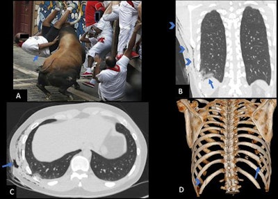 A: A 42-year-old man gored in the right side of the chest wall. B: Coronal view shows a pulmonary contusion (arrow) and subcutaneous emphysema (arrowheads). There is no pneumothorax. C: Axial view shows the entrance wound (arrow). D: Image from 3D VRT scan shows a displaced fracture of the 10th right rib and a nondisplaced fracture of the 12th left rib.