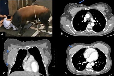 A: A 50-year-old woman gored by a bull in the right breast. B: CT image in the axial plane, with the arrow showing entrance wound. C: Coronal view shows subcutaneous emphysema (arrowheads). D: Axial view at a lower level shows a breast prosthesis with an irregular contour of the surface, findings suggestive of implant rupture (patient had gel effusion through the wound).