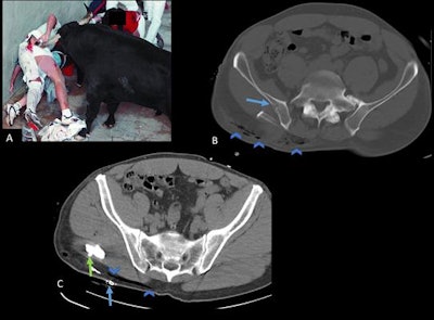 A: A 49-year-old man gored five times by a bull in the right lower limb and pelvis. B: Pelvic CT image shows a fracture in the wing of the ilium (arrow) and subcutaneous emphysema (arrowheads). C: Before the CT scan, the patient had already had a first surgical management of the wound at the onsite medical facility at the bull run. Arrowheads show the direction of one of the wounds. Also, an entrance wound with surgical suture (blue arrow) and a Penrose drain (green arrow) are seen.