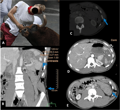 A: Man gored by a bull. The clinical examination revealed that the wound had a superior direction. B: Coronal view shows the entrance wound above the iliac crest (arrow). Splenic laceration shows shattered spleen with active bleeding and hemoperitoneum (arrowhead). C: Image shows a fracture of the 11th left rib. D and E: Images show the extension of the hematoma and hemoperitoneum.