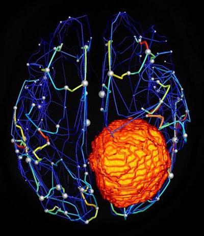 Structural brain network of a patient with a meningioma, or brain tumor (orange). Distinct regions of the brain are depicted as spheres, with larger size indicating increasing relative importance within the network. Image courtesy of Hannelore Aerts.