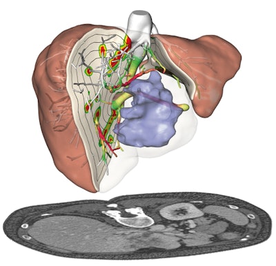 Presurgical planning and risk analysis for the removal of a centrally located liver tumor. The patient-specific 3D model (top) based on CT scans (bottom) of the liver. All images courtesy of Fraunhofer MEVIS.