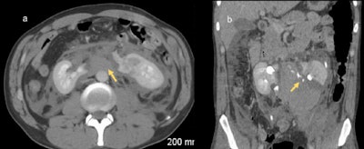 A 33-year-old man following a road traffic accident. There is fragmentation of a horseshoe kidney with a large retroperitoneal hematoma (a) and extravasation of contrast-enhanced urine from the collecting system indicating collecting system injury (b). Horseshoe kidneys are more vulnerable to injury in blunt abdominal trauma due to their position anterior to the spinal column. All images courtesy of Dr. Marie Bambrick. © Radiology Department, St James's Hospital, Dublin.